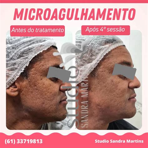 Qual O Tratamento Para O Micro - O guia completo dos cuidados pós microagulhamento em Brasília para uma ...