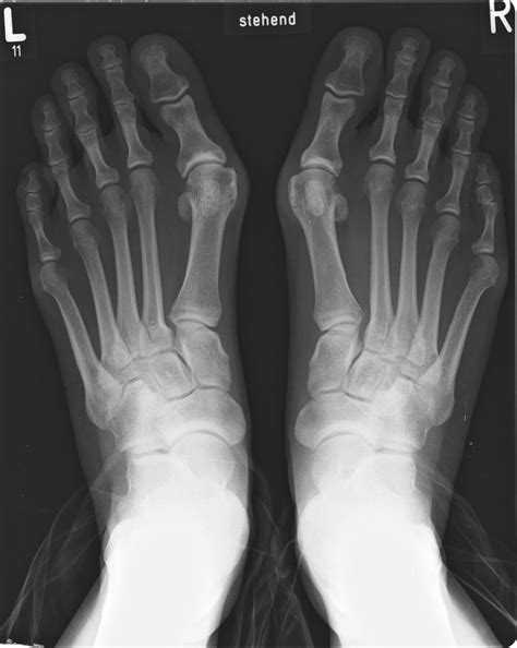 Hammer Toes Xray CALCANEAL Spur Or Lenoir Spur Or Calcaneal Exostosis