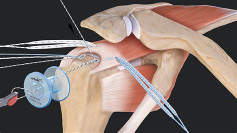 Arthrex Speedbridge Rotator Cuff Repair With Allosync Demineralized