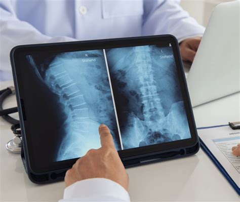 xlif spine surgery       santa rosa