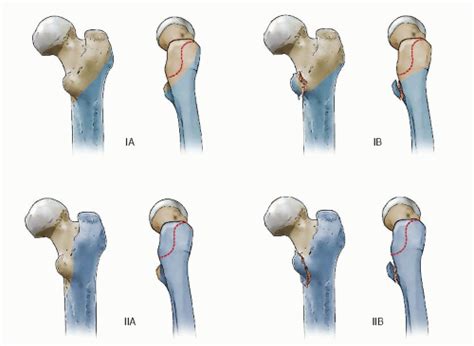 subtrochanteric femur fractures intramedullary nailing