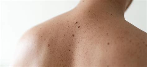 Moles Causes and Solutions | SILKOR Kuwait