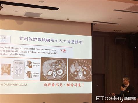 揪早期胰臟癌！台大醫院首創ai偵測肉眼難見腫瘤 準確率達9成 Ettoday健康雲 Ettoday新聞雲