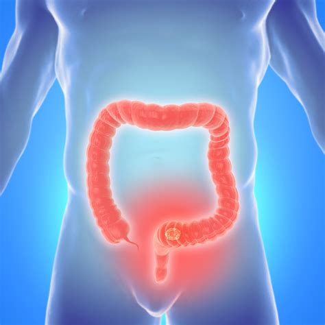 Tumore Del Colon Retto La Scienza Ha Scoperto I Sintomi A Cui Fare