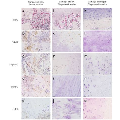 Influence Of The Invasion Of Pannus In The Cartilage Area On