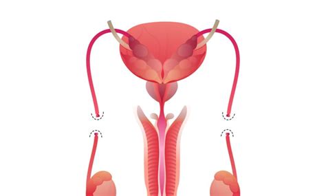 Vantagens E Desvantagens Da Vasectomia Dr Raul Messias Urologista