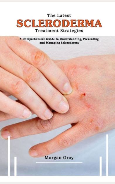 The Latest Scleroderma Treatment Strategies A Comprehensive Guide To Understanding Preventing