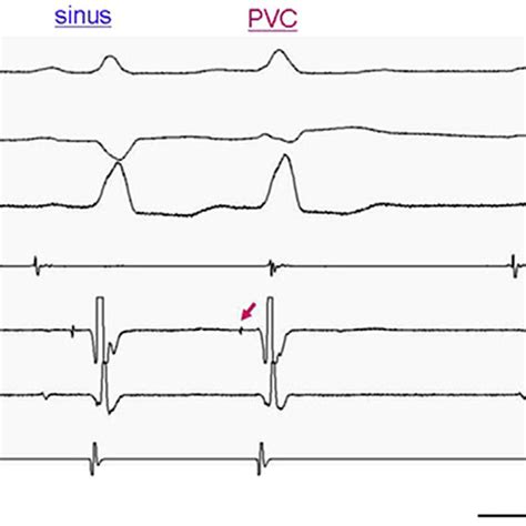 Intracardiac Electrocardiogram The Ectopic Beats Turned Out To Be Download Scientific Diagram