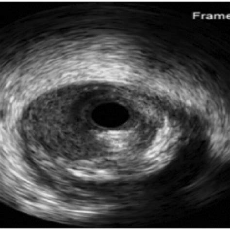 healthy ivus image  ivus image  mild calcification class