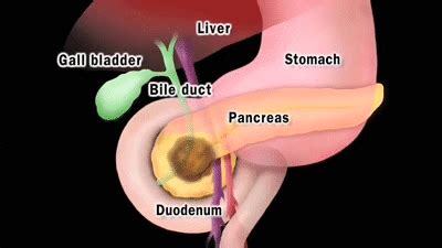 Pancreatic Cancer About Pancreatic Cancer On Make A