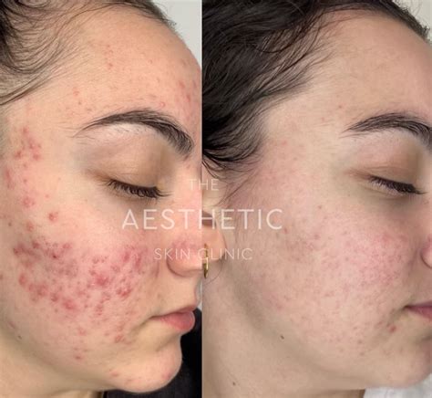 Acne Theaestheticskinclinic