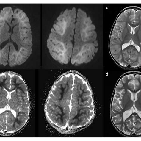 Imaging Completed On Day 5 Of Illness Shows Diffusion Restriction A