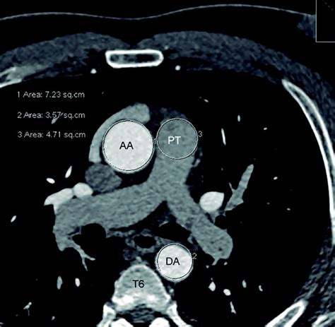 Sex Specific Parameters Of Ascending Aorta Descending Aorta And Pulmonary Trunk By Computed