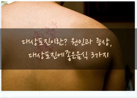 대상포진이란 원인과 증상 대상포진에좋은음식 3가지 네이버 블로그