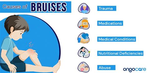 Bruises Causes Symptoms And Treatment A Complete Guide