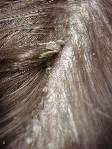 Лишай На Голове Фото Лечение — Фото Картинки