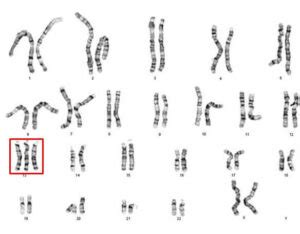 Patau Syndrome: Symptoms, Causes, Treatment | Its Psychology