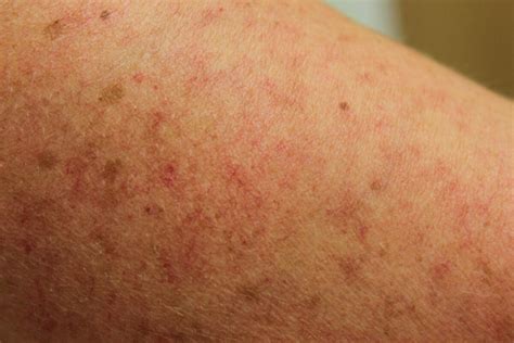 Mastocytosis Systemic Rash