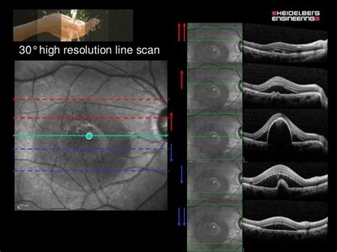 Spectralis Oct Normal Anatomy And Systematic Interpretation