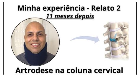 Relato Sobre Minha Cirurgia Na Coluna Cervical Descompress O Por