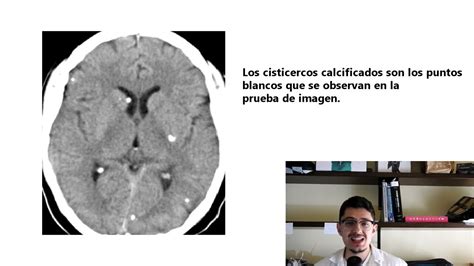 Cisticercosis Y Neurocisticercosis S Ntomas Tratamiento Y