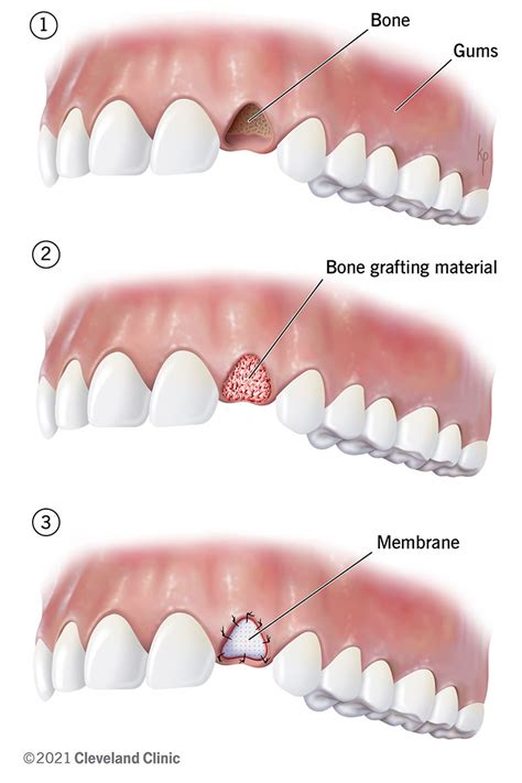 Dental Bone Graft Process Purpose And Healing