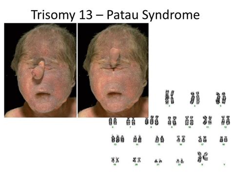 Ppt Karyotype Powerpoint Presentation Id