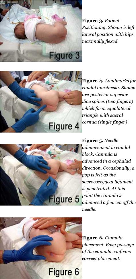 Figure 6 From Complications Associated With Epidural And Caudal