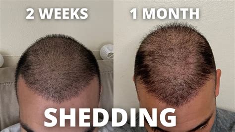 One Month Hair Transplant Update 4000 Grafts 9k Total Via Fue Dr Sethi Eugenix Youtube