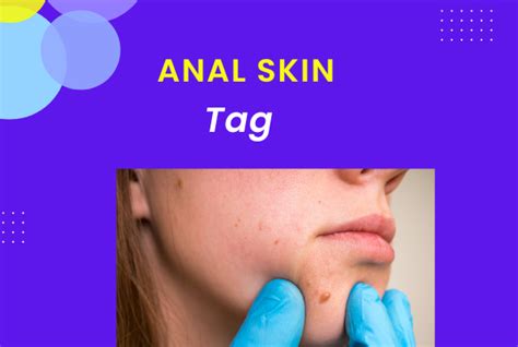 Know Who Are At Risk Of Growing Anal Skin Tags UniWorld News
