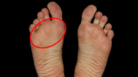 What Is That Pain In The Ball Of My Feet Triumph Institute