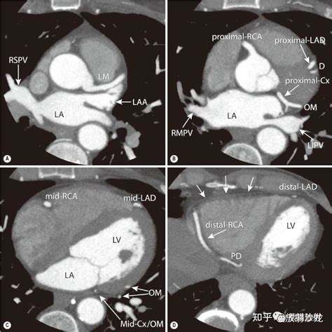 冠状动脉CT相关概念解剖 知乎