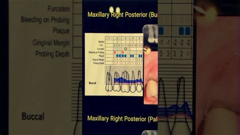 How To Read A Perio Chart