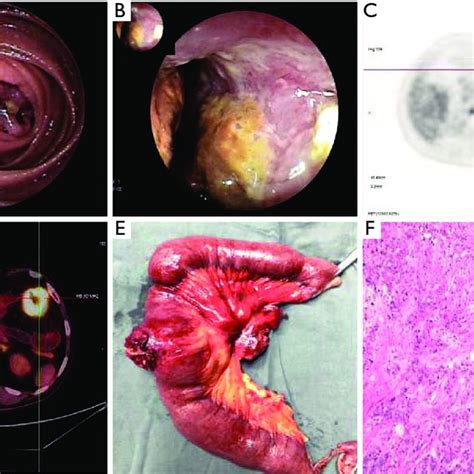 The Small Intestine Squamous Cell Carcinomas A B Endoscopic Pictures