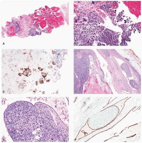 Fibroepithelial Neoplasms Basicmedical Key