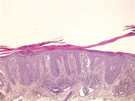 psoriasis histology – Telegraph