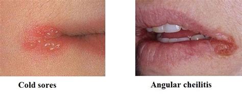What is Angular cheilitis? Symptoms, Types, Causes, Chronic, Treatments ...