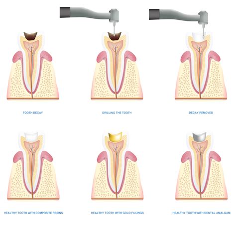 How Do Cavity Fillings Work Willow Pass Dental Care