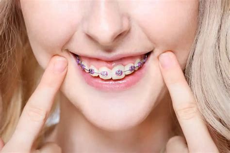 Teeth Straightening Costs And Options With Or Without Braces