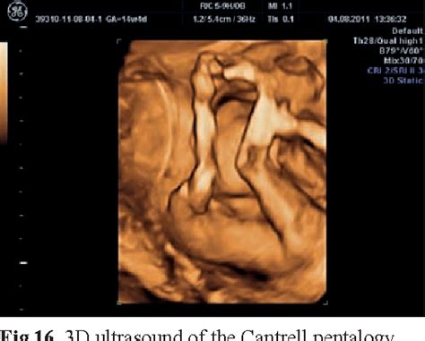 Figure 16 From The Fetal Abdominal Wall Defects Using 2D And 3D