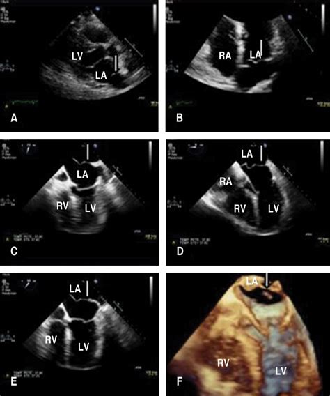 Clinical Case Of Cor Triatriatum In A Patient With Cha2ds2vasc 1 Point