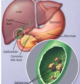 What is a Gallstone? – Causes and Types of Gallstones