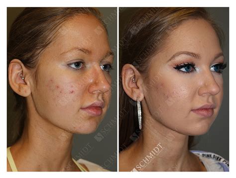 Buccal Fat Removal Before And After Women