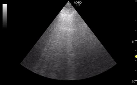 Lung ultrasound: A and B-lines – NephroPOCUS