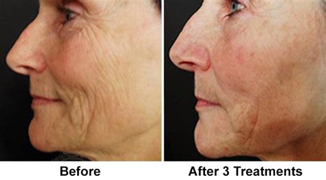 Microneedling New Jersey Slate Medspa