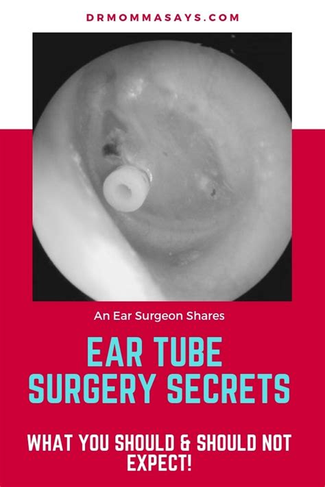 Ear Tube Surgery Secrets What You Should And Should Not Expect Dr