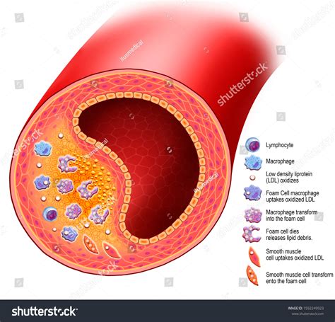 Atherosclerosis Descriptive Illustration Arterial Disease Accumulation