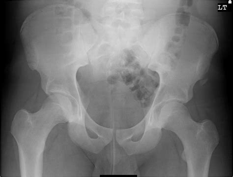 Anterior Superior Iliac Spine X Ray