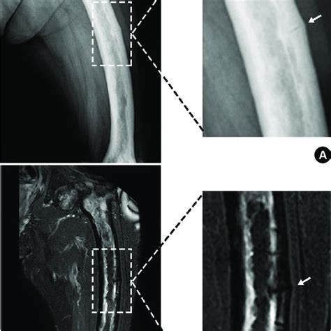 Pdf Stress Fracture Of The Femoral Shaft In Pagets Disease Of Bone