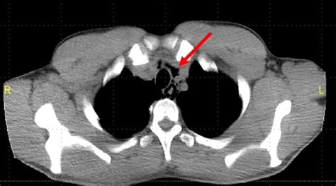 Pneumomediastinum Secondary To Medication Induced Esophageal